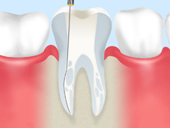 抜歯が必要といわれた方へ――根管治療で歯を残せるかもしれません