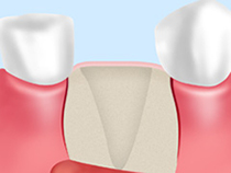 STEP1：歯茎の切開