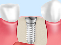 STEP3：インプラント埋入