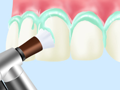 PMTC(Professional Mechanical Tooth Cleaning)