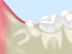 奥歯の痛みは「親知らず」が原因かもしれません